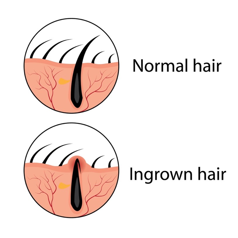 Illustration of normal and ingrown hair.